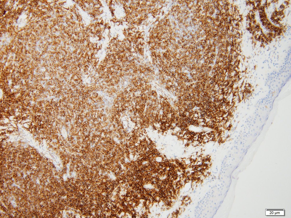 Figure 16 CD56